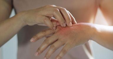 TCM Hauterkrankungen