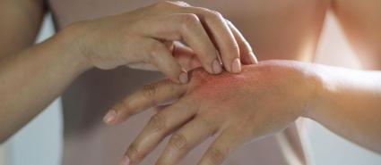 TCM Hauterkrankungen